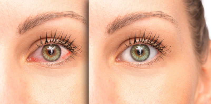 A comparison of a dry eye before vs after treatment