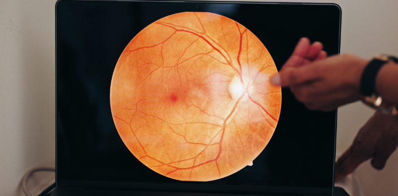 An image of an eye scan and screen in a consultation